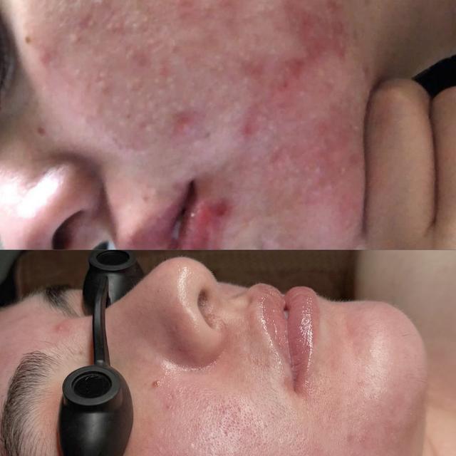 ACNE BOOTCAMP